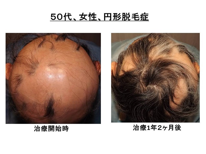 円形脱毛症　病院""